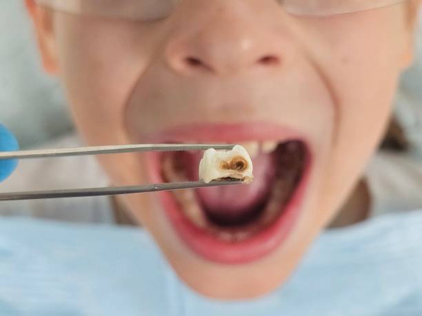 Best Urgent Tooth Repair  in Mayo, MD